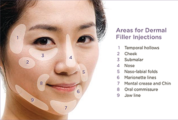 Injectables and Dermal Fillers – Flatirons Dermatology liposuction areas diagram 