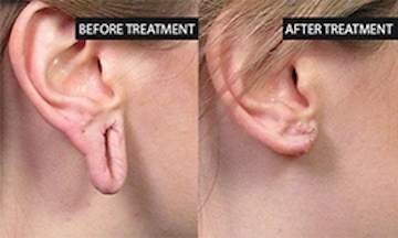 ear torn from earring